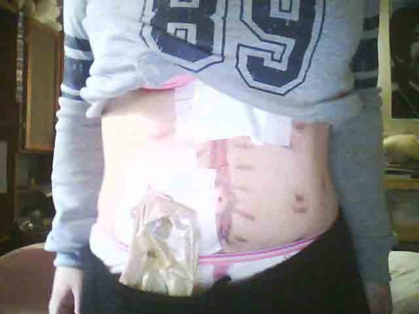 My ileostomy (poo bag) and some fresh looking scars circa mid 2009.